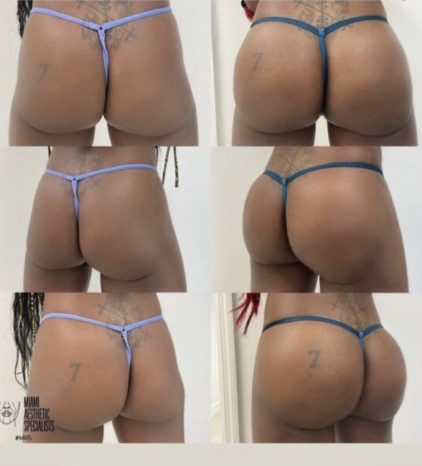 Azealia Banks Shows off Butt Lift