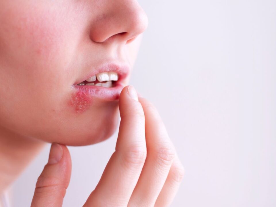 Women with Herpes